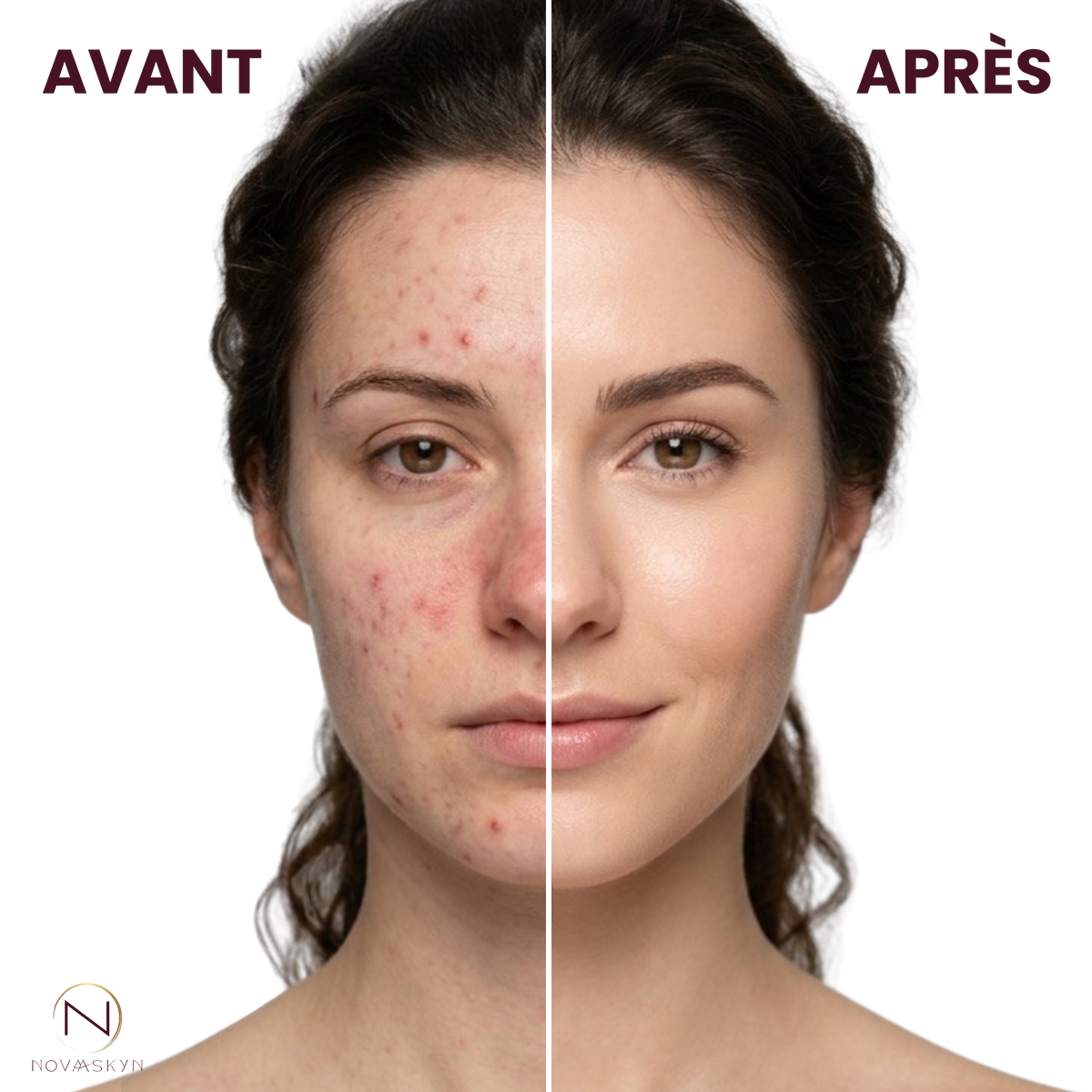 Masque LED de luminothérapie - Novaaskyn